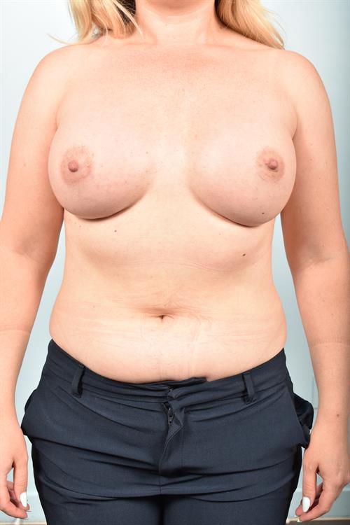 Sub-Fascial Breast Augmentation After Photo | Phoenix and Scottsdale, AZ | Scottsdale Center for Plastic Surgery