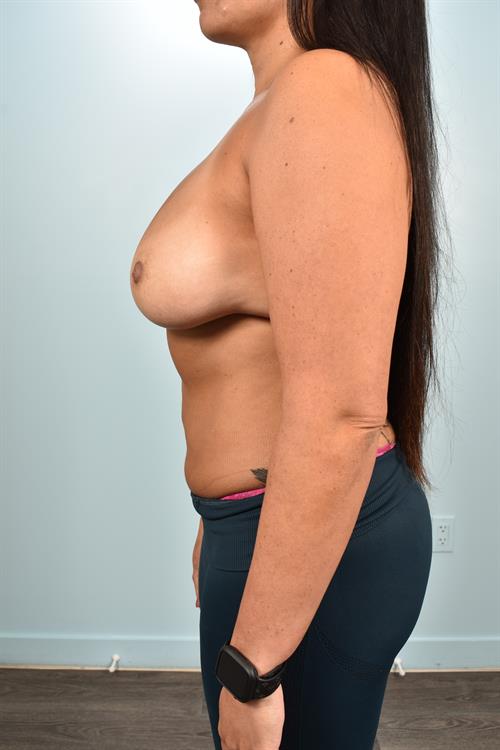 Sub-Fascial Breast Augmentation Before Photo | Phoenix and Scottsdale, AZ | Scottsdale Center for Plastic Surgery