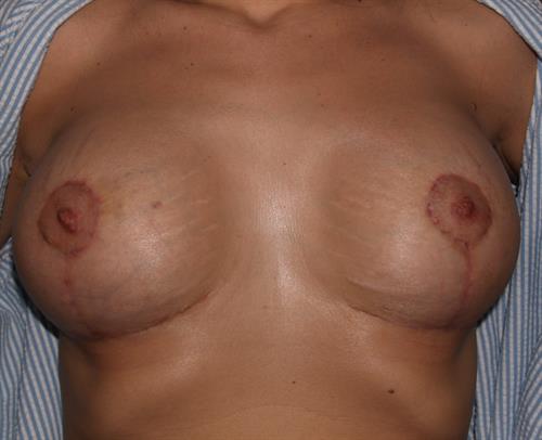 Breast Lift (Mastopexy) After Photo | Phoenix and Scottsdale, AZ | Scottsdale Center for Plastic Surgery