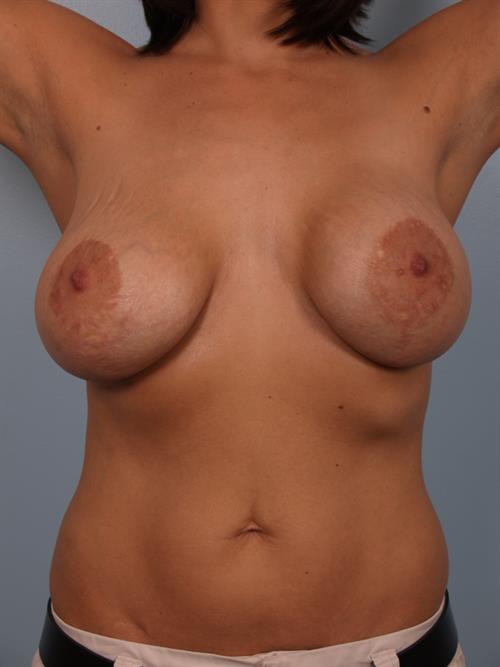 Breast Lift (Mastopexy) Before Photo | Phoenix and Scottsdale, AZ | Scottsdale Center for Plastic Surgery