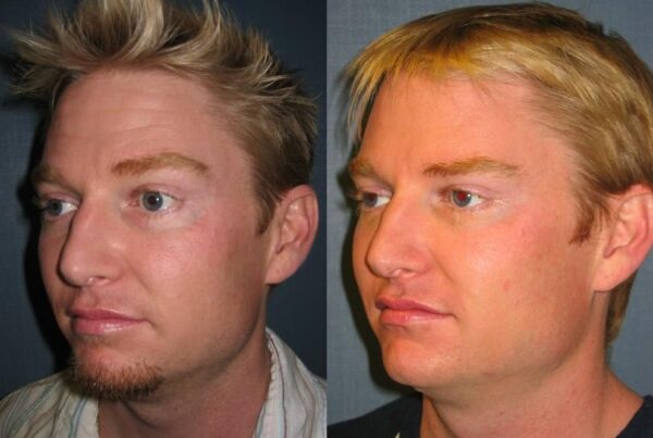 Botox 1