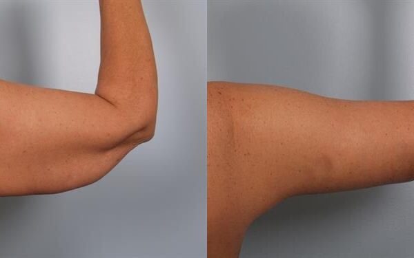 Brachioplasty (Arm Lift) 2