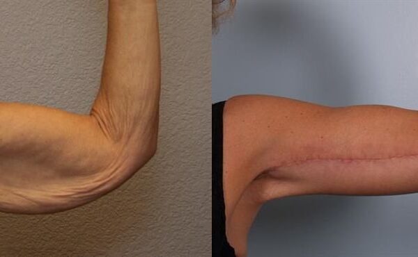 Brachioplasty (Arm Lift) 3