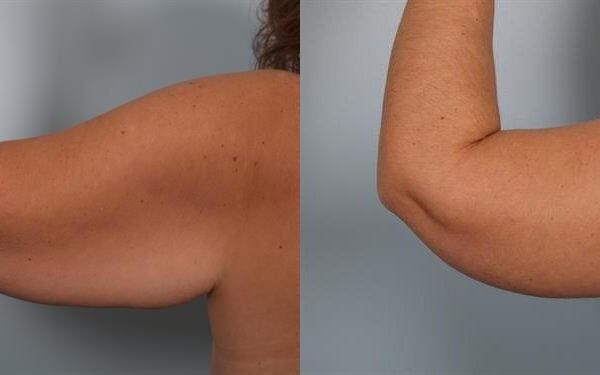 Brachioplasty (Arm Lift) 4