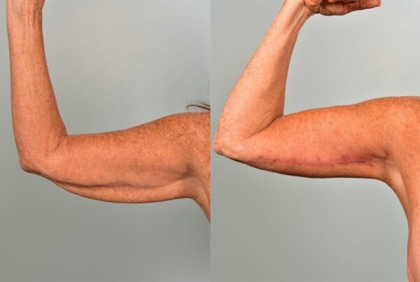 Brachioplasty (Arm Lift) 5
