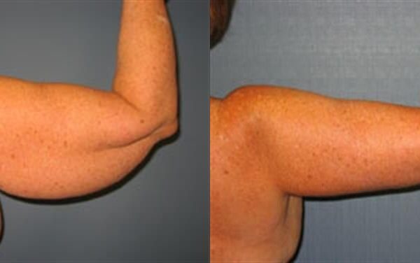 Brachioplasty (Arm Lift) 6