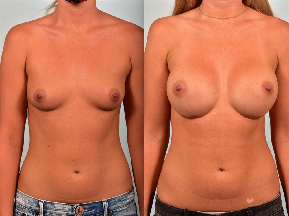 Breast Augmentation 1