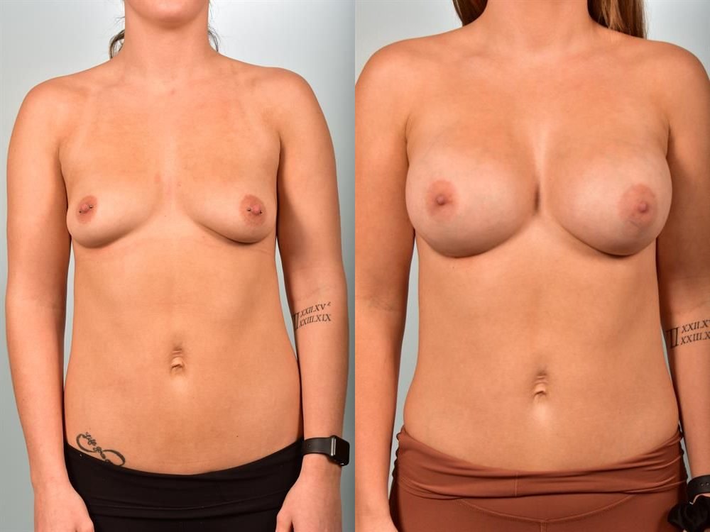 Breast Augmentation 10