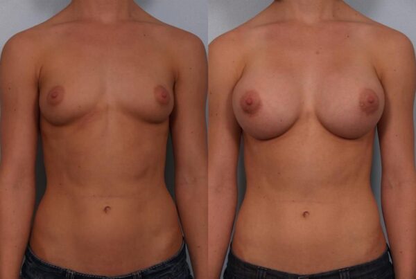 Breast Augmentation 100