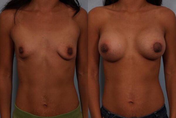 Breast Augmentation 101