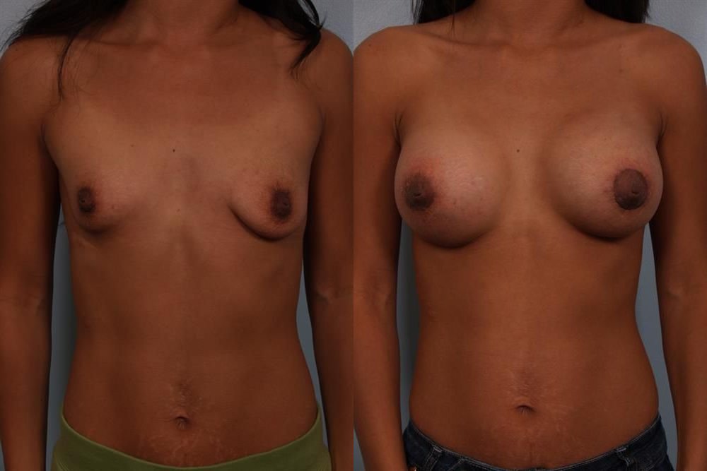 Breast Augmentation 101