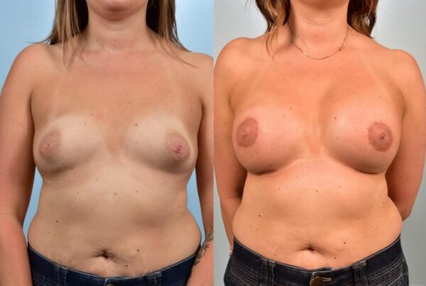 Breast Augmentation 102