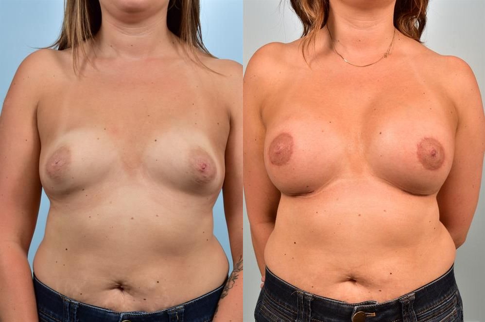 Breast Augmentation 102