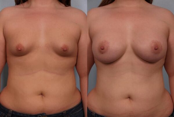 Breast Augmentation 103