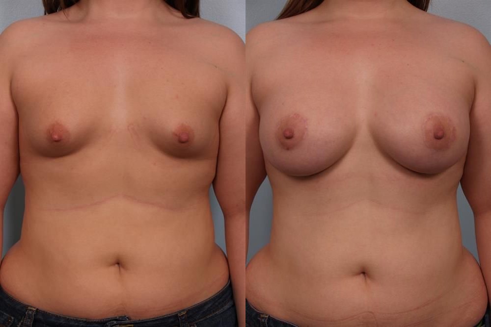 Breast Augmentation 103
