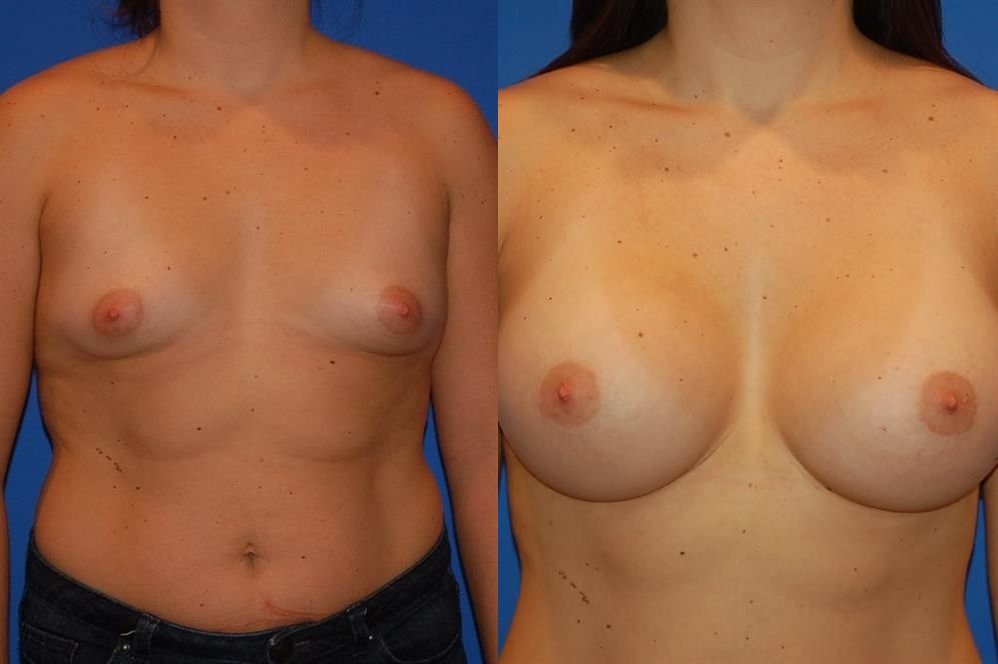 Breast Augmentation 104