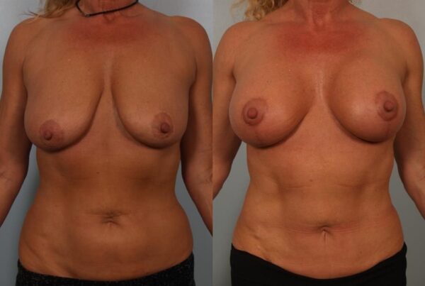 Breast Augmentation 106