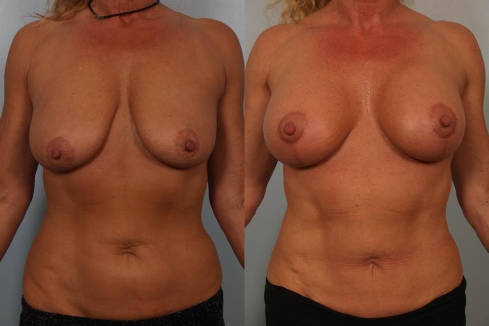 Breast Augmentation 106