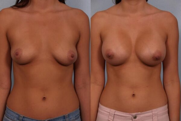 Breast Augmentation 107