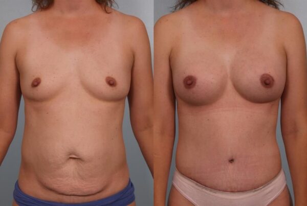 Breast Augmentation 108