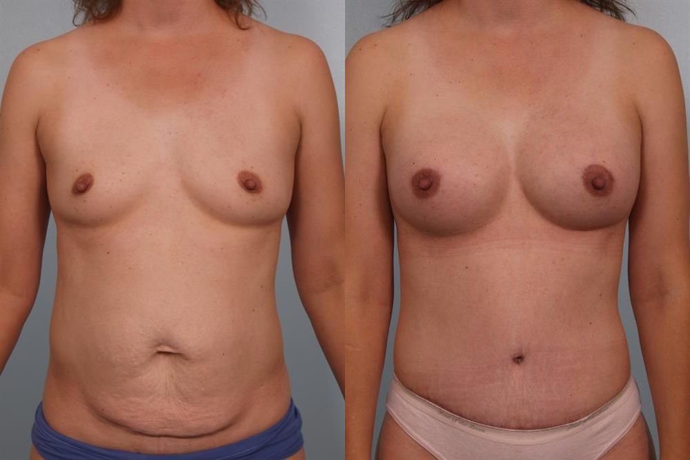 Breast Augmentation 108