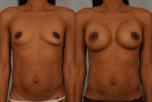 Breast Augmentation 110