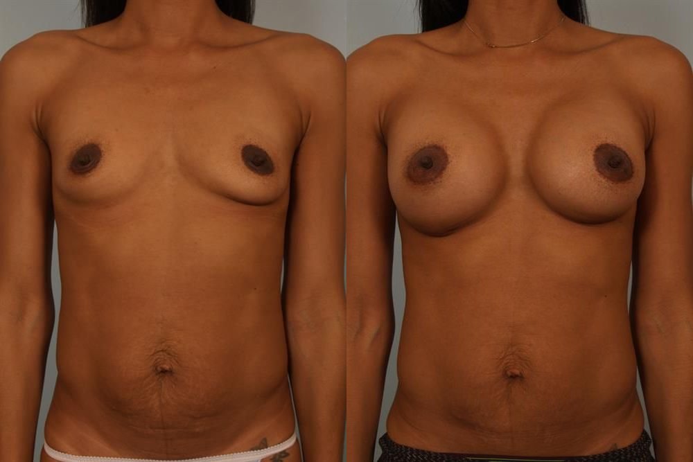 Breast Augmentation 110