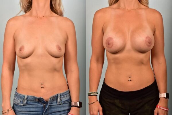 Breast Augmentation 111
