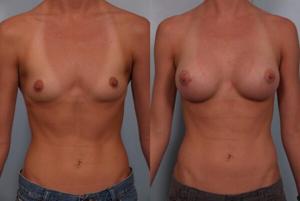 Breast Augmentation 112
