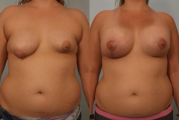 Breast Augmentation 113