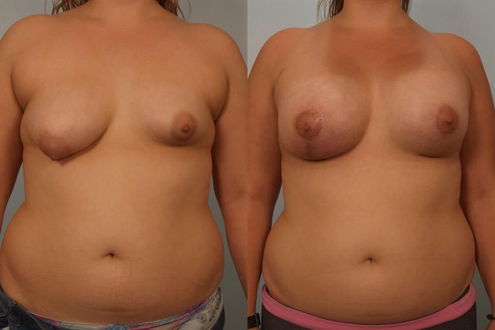 Breast Augmentation 113