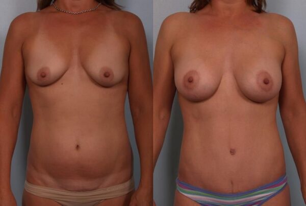 Breast Augmentation 114