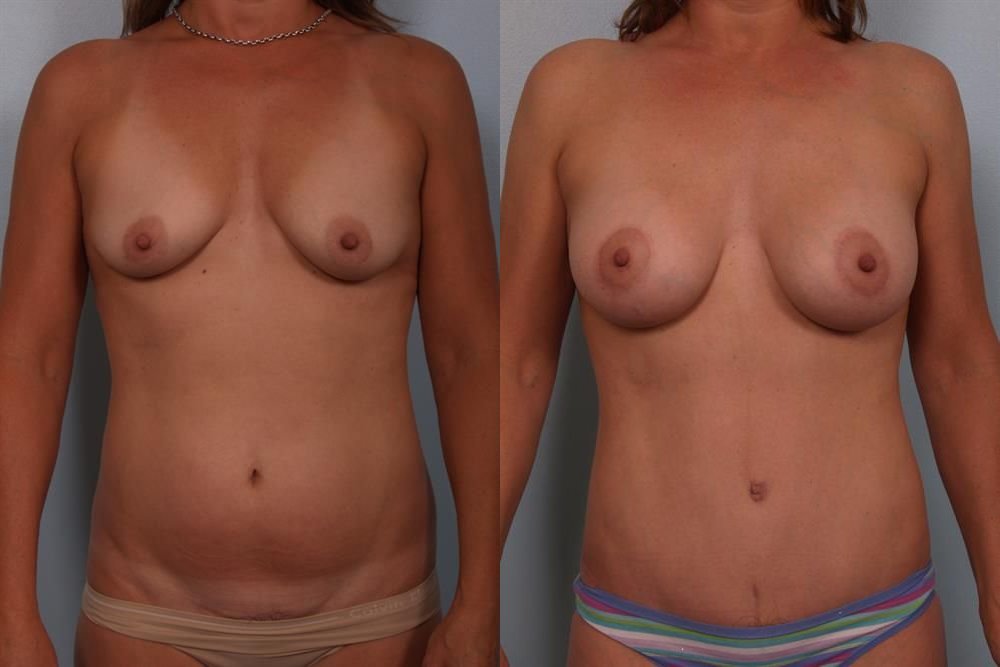 Breast Augmentation 114