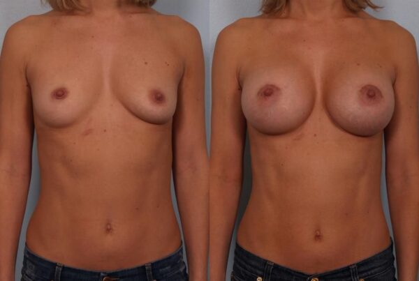 Breast Augmentation 115