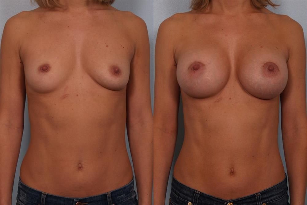 Breast Augmentation 115