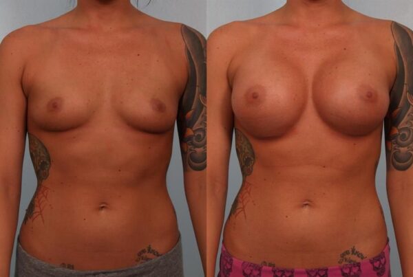 Breast Augmentation 117