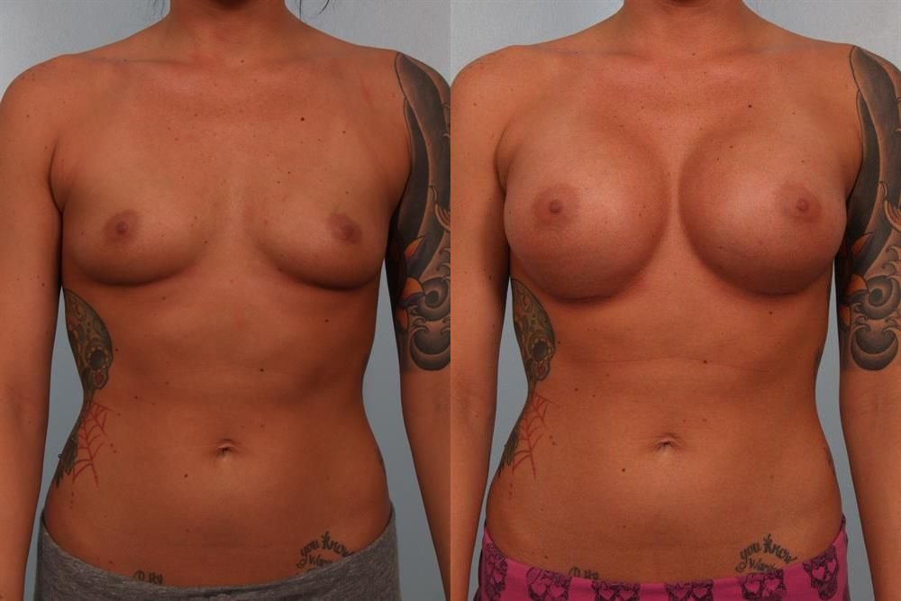 Breast Augmentation 117