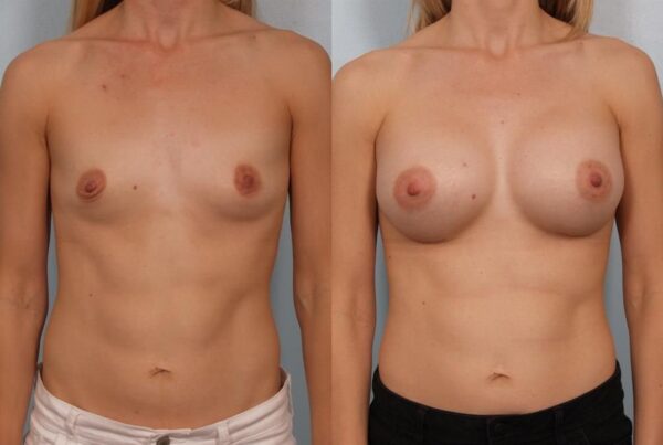 Breast Augmentation 118