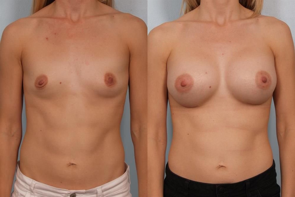 Breast Augmentation 118