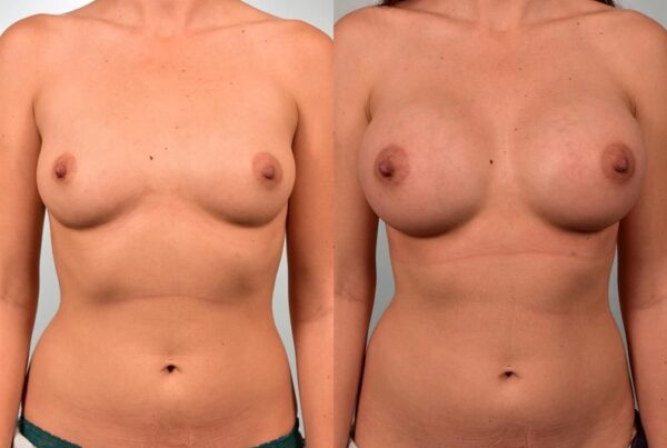 Breast Augmentation 119