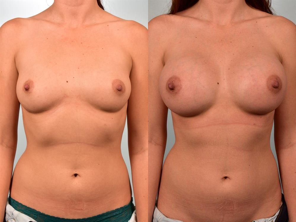 Breast Augmentation 119