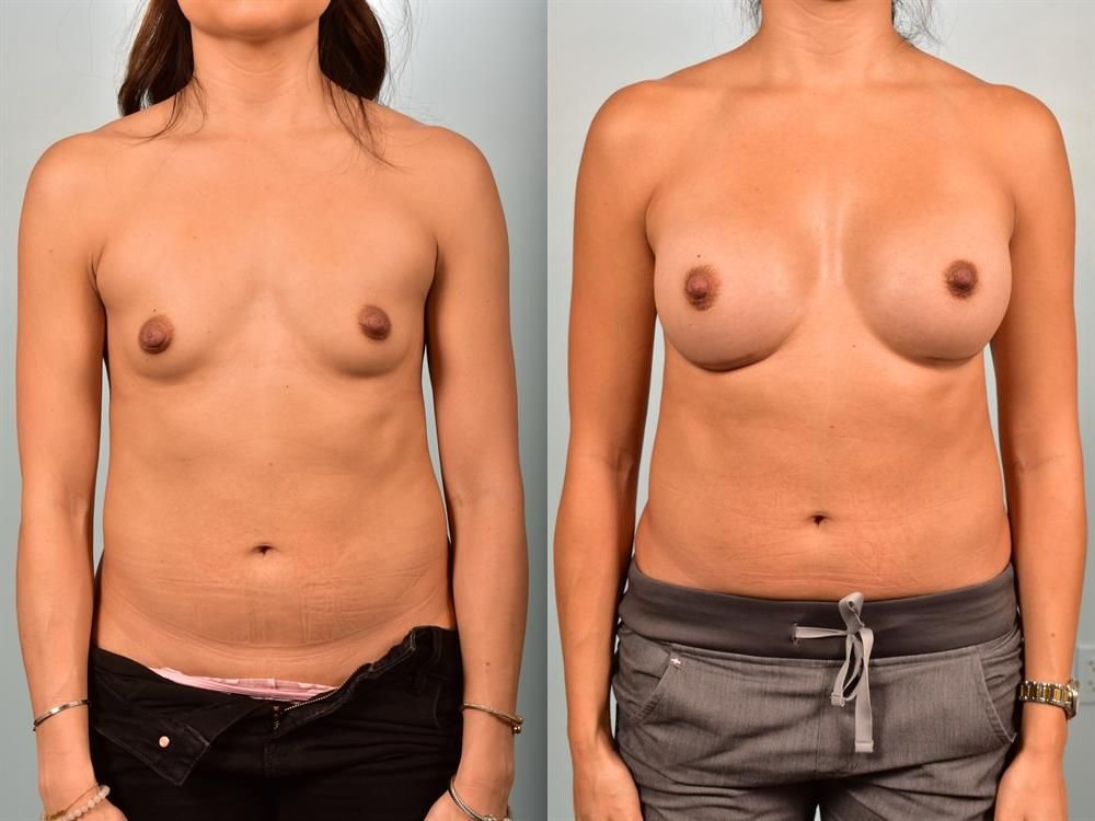 Breast Augmentation 12