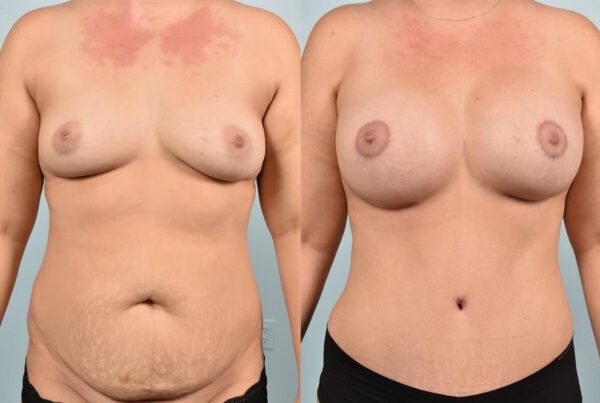 Breast Augmentation 120