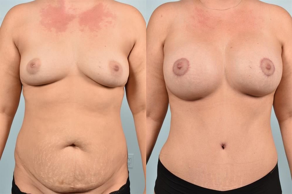 Breast Augmentation 120