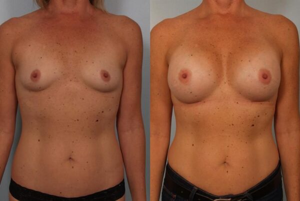 Breast Augmentation 121