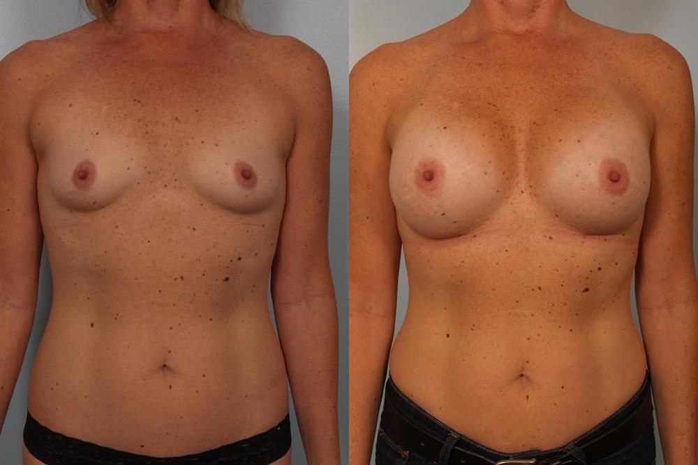 Breast Augmentation 121