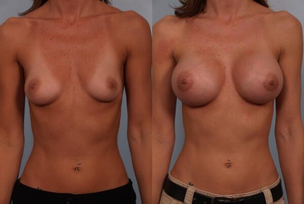 Breast Augmentation 122