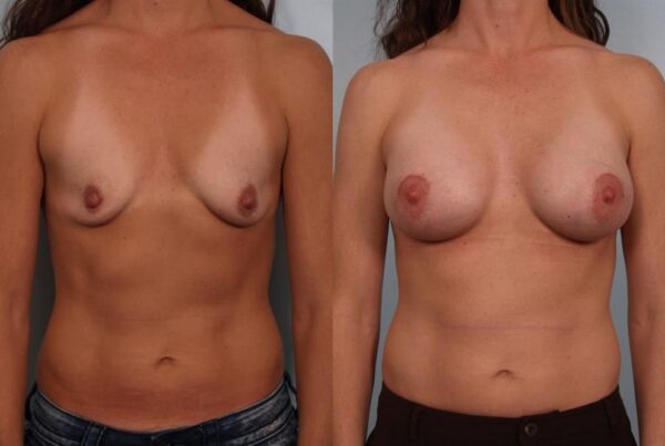 Breast Augmentation 123