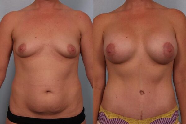 Breast Augmentation 124