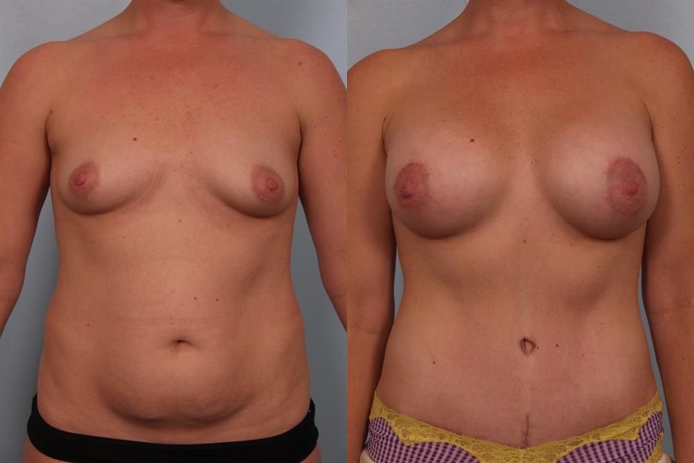 Breast Augmentation 124